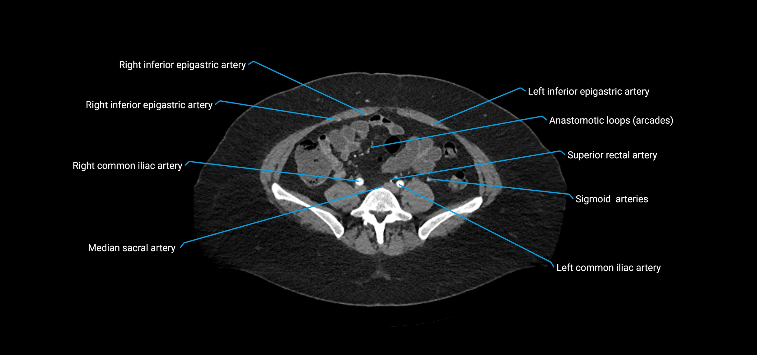 CTA abdomen axial cross sectional anatomy labelled image_163 (2).webp